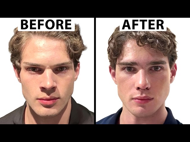 Clavicular's NEW FACE | Plastic Surgery Analysis